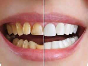 En BMG Odontología Integral Especializada | Dr. Benjamín Galván, ubicada en Buenos Aires, ofrecemos soluciones dentales integrales desde el 15 de mayo de 2012. Nuestros servicios incluyen Rehabilitación Oral, Implantes Dentales, Cirugía, Carillas Dentales, Estética Dental, Corona Dental de Cerámica Pura y Periodoncia. Nos destacamos por nuestra dedicación absoluta, atención personalizada y uso de materiales importados de primera calidad. Nuestra avanzada planificación digital asegura resultados precisos y duraderos, incluso en los casos más complejos. Si estás en Buenos Aires y buscas una clínica dental de confianza, contáctanos hoy mismo para agendar tu consulta y comienza tu camino hacia una sonrisa perfecta con Dr. Esp. Benjamín Galván.