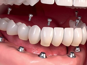 En BMG Odontología Integral Especializada | Dr. Benjamín Galván, ubicada en Buenos Aires, ofrecemos soluciones dentales integrales desde el 15 de mayo de 2012. Nuestros servicios incluyen Rehabilitación Oral, Implantes Dentales, Cirugía, Carillas Dentales, Estética Dental, Corona Dental de Cerámica Pura y Periodoncia. Nos destacamos por nuestra dedicación absoluta, atención personalizada y uso de materiales importados de primera calidad. Nuestra avanzada planificación digital asegura resultados precisos y duraderos, incluso en los casos más complejos. Si estás en Buenos Aires y buscas una clínica dental de confianza, contáctanos hoy mismo para agendar tu consulta y comienza tu camino hacia una sonrisa perfecta con Dr. Esp. Benjamín Galván.