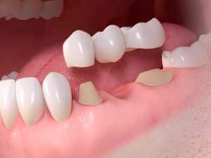 En BMG Odontología Integral Especializada | Dr. Benjamín Galván, ubicada en Buenos Aires, ofrecemos soluciones dentales integrales desde el 15 de mayo de 2012. Nuestros servicios incluyen Rehabilitación Oral, Implantes Dentales, Cirugía, Carillas Dentales, Estética Dental, Corona Dental de Cerámica Pura y Periodoncia. Nos destacamos por nuestra dedicación absoluta, atención personalizada y uso de materiales importados de primera calidad. Nuestra avanzada planificación digital asegura resultados precisos y duraderos, incluso en los casos más complejos. Si estás en Buenos Aires y buscas una clínica dental de confianza, contáctanos hoy mismo para agendar tu consulta y comienza tu camino hacia una sonrisa perfecta con Dr. Esp. Benjamín Galván.